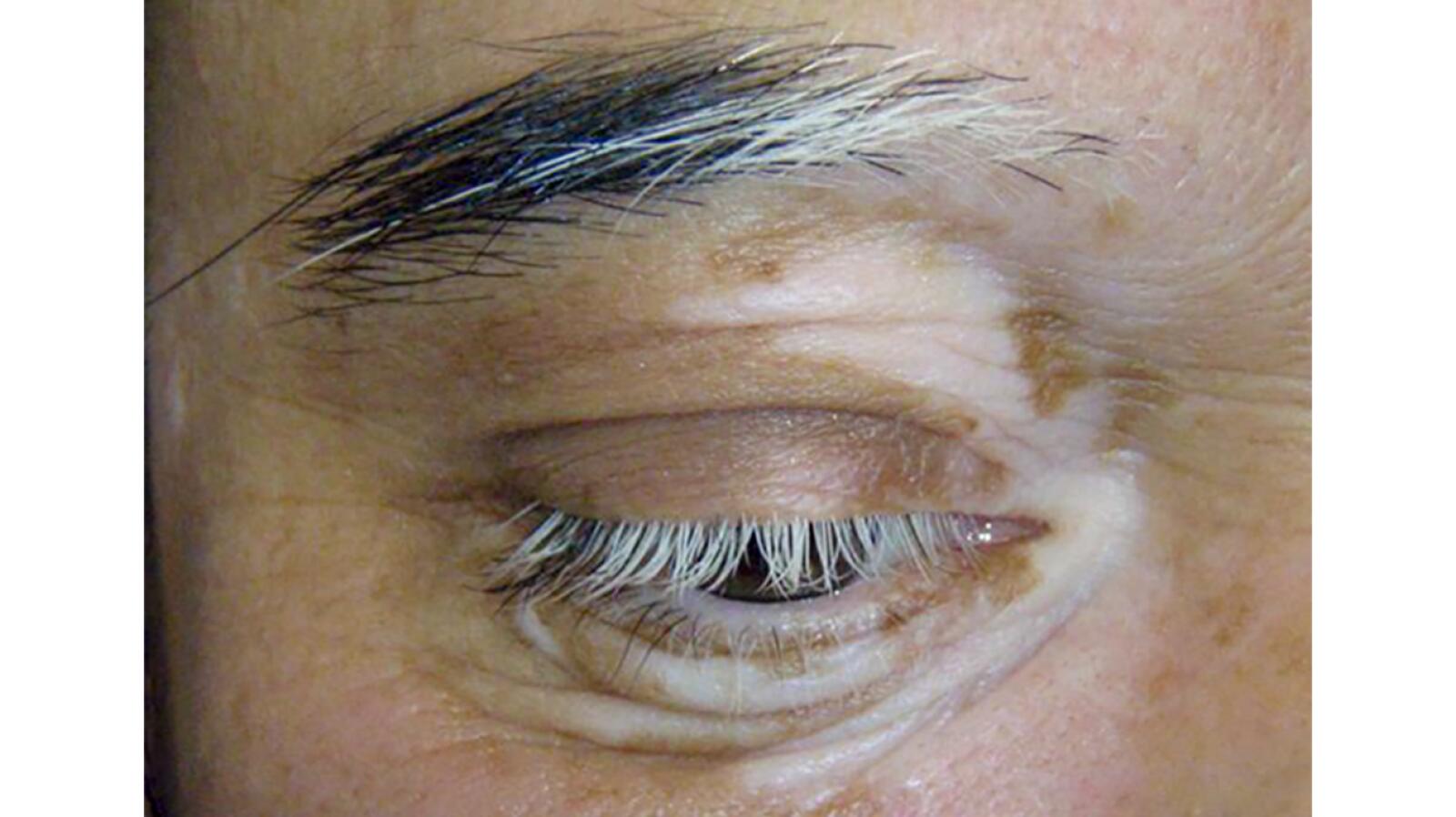 Poliosis: Appearance, Causes, Treatments, and More